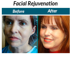 facial